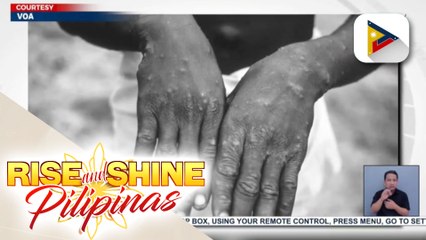 WHO, nakapagtala na ng 80 cases ng monkeypox mula sa 12 bansa