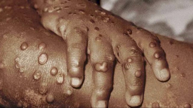 7dias-La-viruela-del-mono-Qué-es-y-qué-tanto-debe-preocuparnos-230522