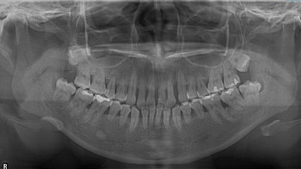 bd-causas-de-perdida-de-hueso-dental-240522