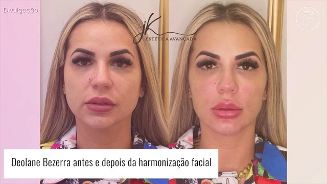 Deolane, Gretchen, Joelma, Gkay e mais: veja o antes e depois de famosos adeptos da harmonização facial!