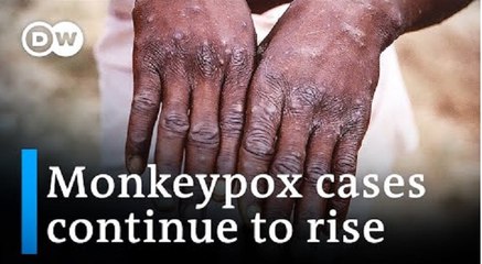 Monkeypox: Health officials assess response as cases spread