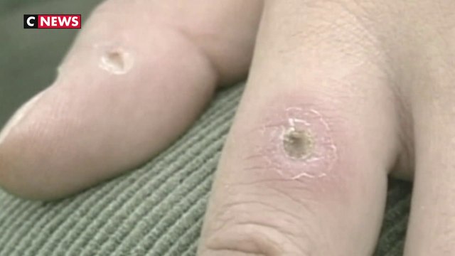 Variole du singe : la HAS recommande de vacciner les cas contact