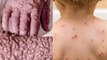 Monkeypox और Smallpox में क्या है Difference। Expert Advice। Boldsky