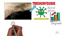 Trichomycosis - Colour change in armpit and pubic hair