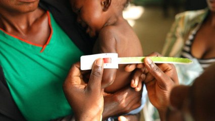 Malnutrición: el hambre oculta, un problema mundial