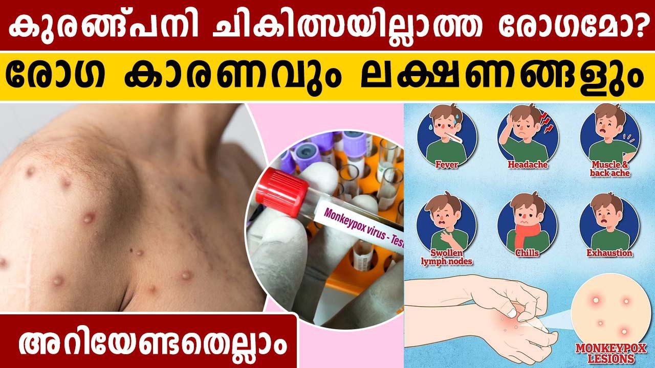 കുരങ്ങ്പനി ഭീതിയിൽ ലോകം, ചികിത്സയില്ലാത്ത രോഗമോ | OneIndia Malayalam