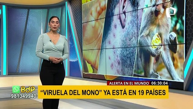 Viruela del mono: brote de enfermedad ya está en al menos 19 países