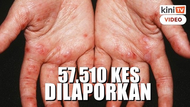 Kes HFMD meningkat 24 kali ganda dalam lima bulan - Khairy