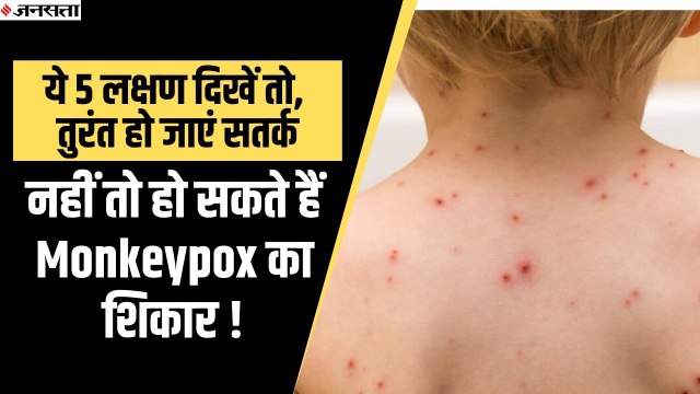Monkeypox Virus: ये लक्षण दिखें तो तुरंत हो जाएं सतर्क, नहीं तो हो सकते हैं भयंकर बीमारी का शिकार