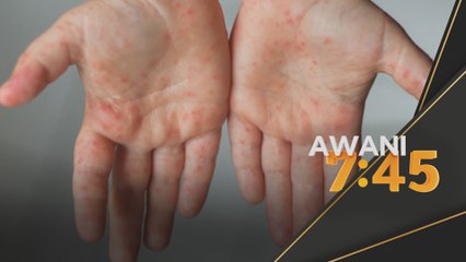 HFMD | Jangan hantar anak jika dijangkiti