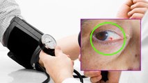High BP से Eyes Damage, Blood Spot से लेकर Optic Neuritis का खतरा | Boldsky