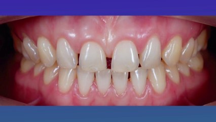 bd-como-corregir-el-espacio-entre-dientes-270522