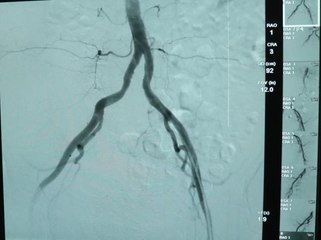 İç kanamalı hasta "anjiyo ile embolizasyon" yöntemiyle sağlığına kavuşturuldu