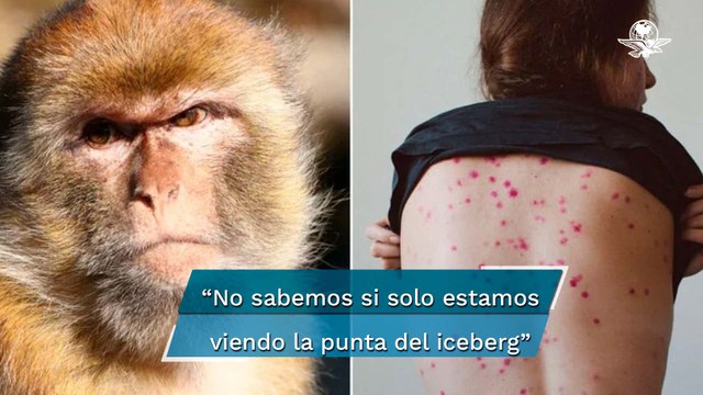 Casos de viruela del mono podrían ser solo la punta del iceberg , dice la OMS