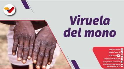 Al Día | Viruela del mono: ¿Cómo evitar su contagio?