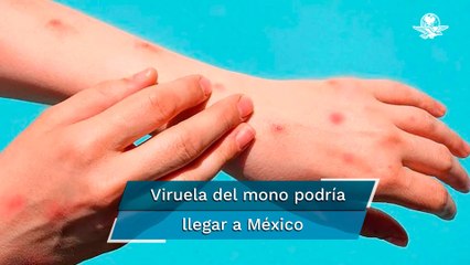 Advierten que viruela del mono puede llegar a México