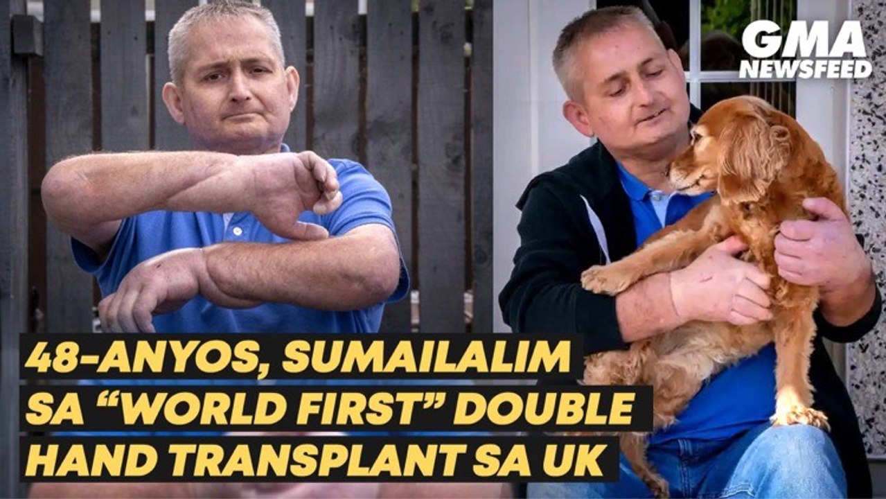 48-anyos, sumailalim sa “world first” double hand transplant sa UK | GMA News Feed