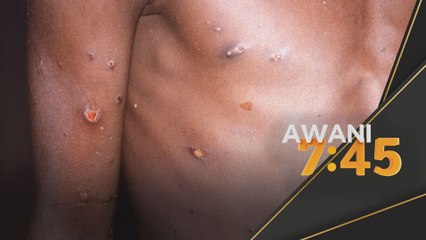 Cacar Monyet | 643 kes dikesan di 26 negara setakat ini - WHO