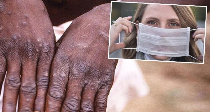 Uzmanından ‘maymun çiçeği virüsü’ için yaş ve maske açıklaması