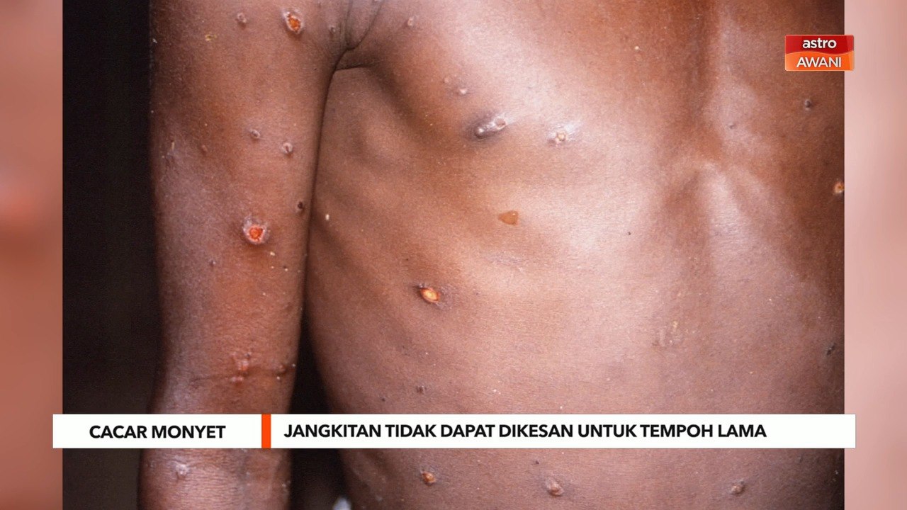 Cacar Monyet | Penularan tidak dapat dikesan untuk tempoh lama - WHO