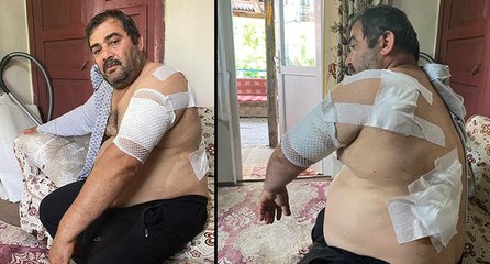 Ayı saldırısına uğrayan vatandaş: Beni öldü zannetti