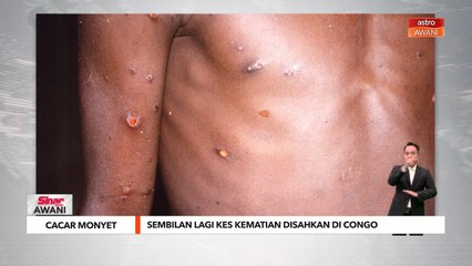 Cacar Monyet | Sembilan lagi kes kematian disahkan di Congo