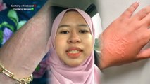 Kulit sensitif mudah naik bintat jika disentuh, gadis ini syak ada kaitan misteri bawah pokok ciku… Orang kata kena ‘ludah jin’