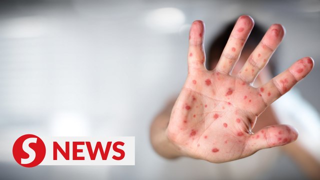 HFMD cases up 28-fold compared to same period last year