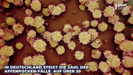 Affenpocken: Was du tun solltest, wenn du vermutest, dich angesteckt zu haben