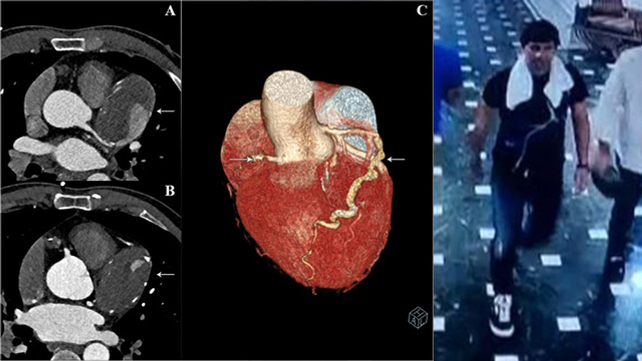 Singer KK Demise Reason: Heart Attack या Heat Stroke, Post Mortem से पहले Doctor Alert | Boldsky
