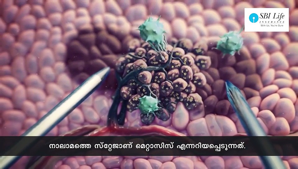 കരള്‍ ക്യാന്‍സര്‍ തിരിച്ചറിയാം; ലക്ഷണങ്ങള്‍ ഇവയാണ്