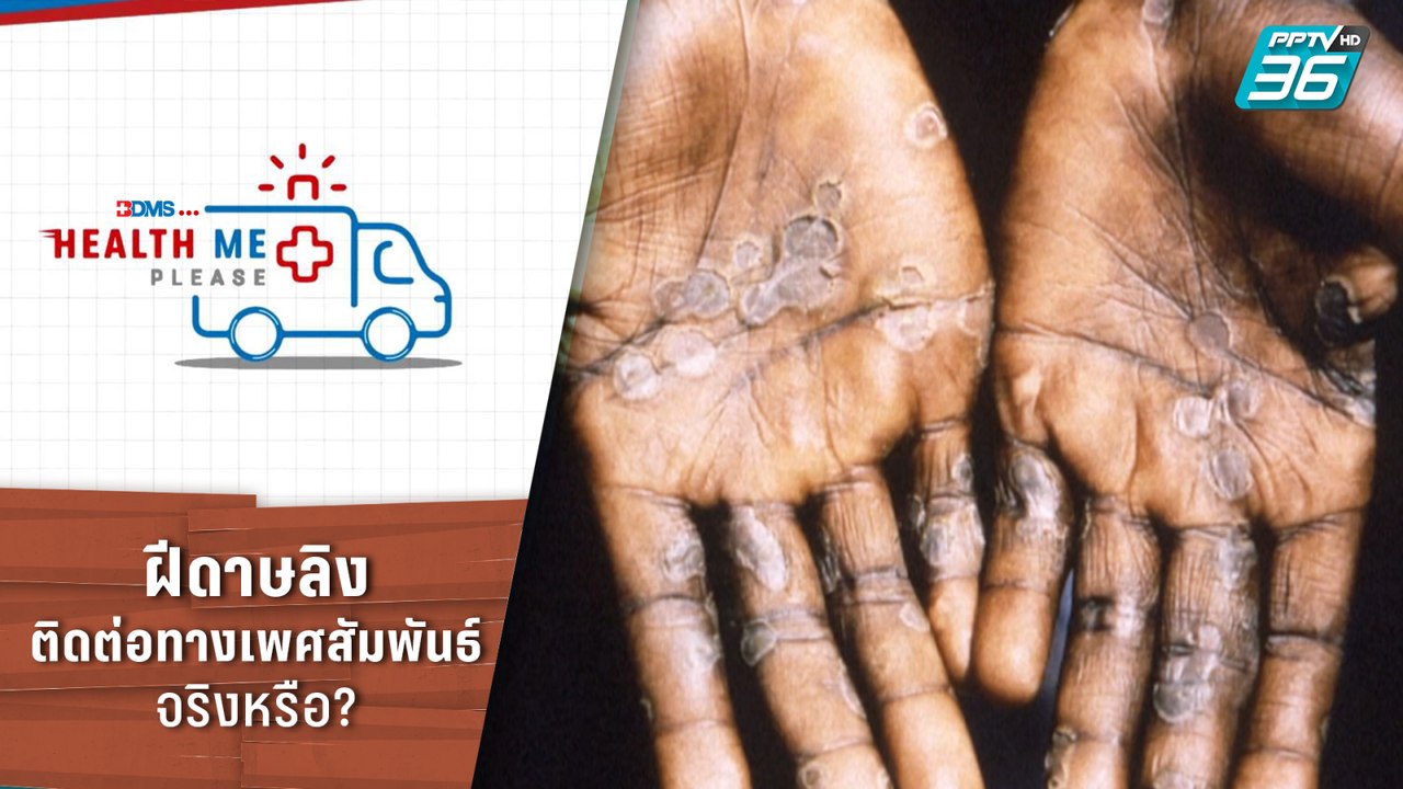 ฝีดาษลิง ติดต่อทางเพศสัมพันธ์ จริงหรือ? | Healt...