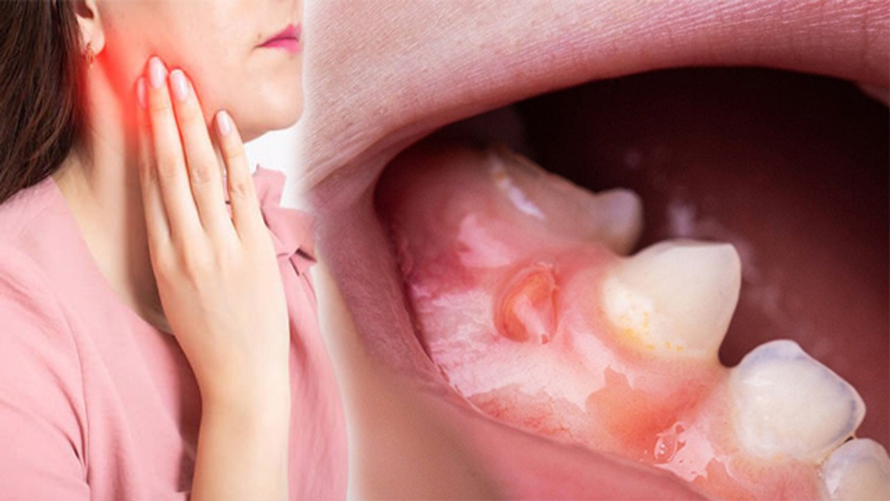 Akal Ki Daad Ke Pas Sujan Kyu Hoti Hai । Pericoronitis Kya Hota Hai । Boldsky