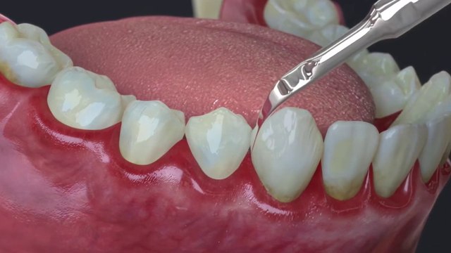 bd-causas-y-tratamientos-de-gingivitis-o-enfermedad-de-las-encias-290523