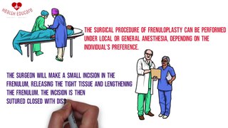 Frenuloplasty: Short Frenulum Surgical treatment