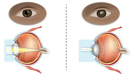 bd-causas-y-tratamientos-de-catarata-300523