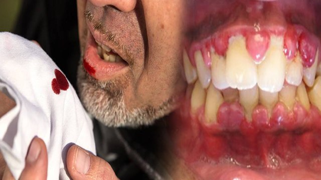 थूक में खून आना Gingivitis से लेकर Pneumonia Symptoms | थूक में खून क्यों आता है | Boldsky