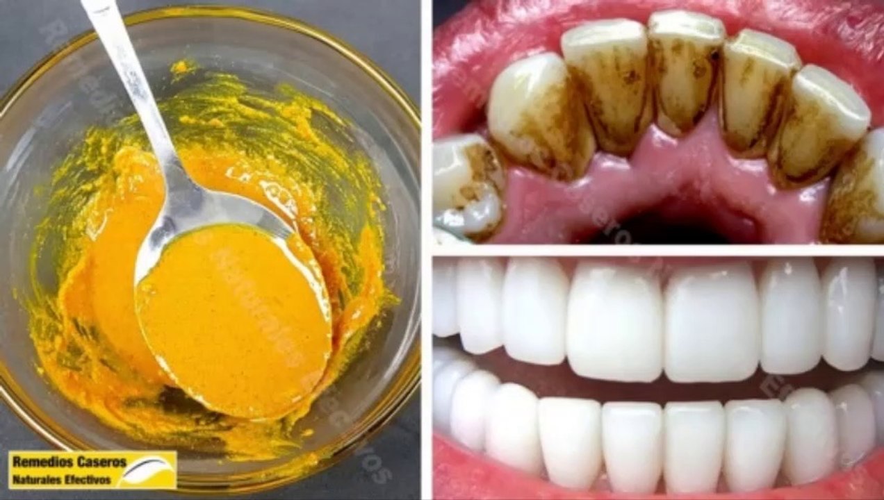 LOGRARAS BLANQUEAR TUS DIENTES AMARILLOS Y SUCIOS EN 3 MINUTOS BRILLARÁN