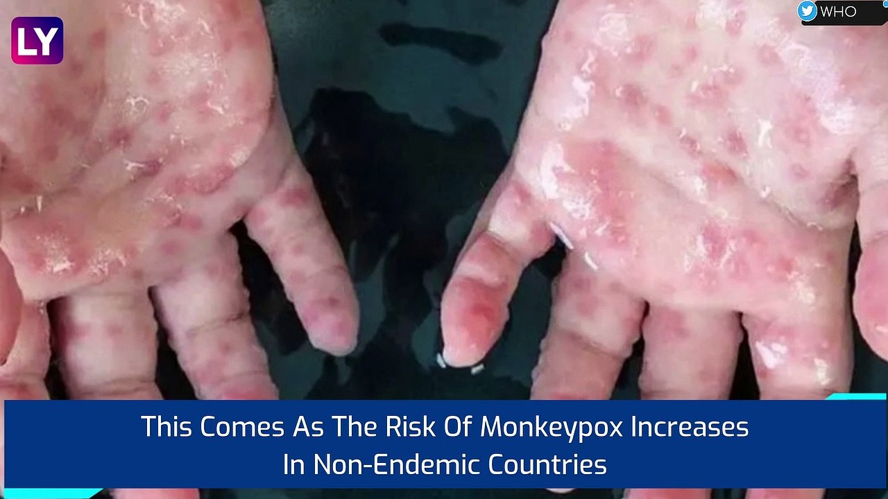 WHO Recommends Smallpox Vaccine As Monkeypox Cases Rise, Says Mass Vaccination Not Needed
