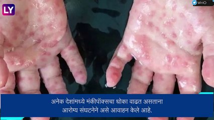 Monkeypox ची वाढती आकडेवारी पाहता स्मॉलपॉक्स लसीकरणाचे आरोग्य संघटनेकडून आवाहन