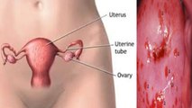 Uterus Ulcer Symptoms in Hindi, बच्चेदानी के मुंह पर छाले का कारण | Boldsky *Health