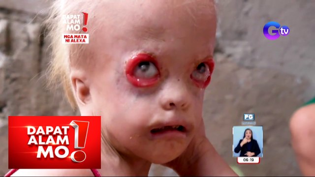 3-anyos na bata, walang talukap at pilikmata! | Dapat Alam Mo!