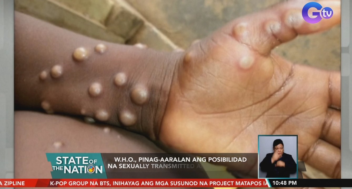 W.H.O., pinag-aaralan ang posibilidad na sexually transmitted ang Monkeypox matapos makita ang virus sa semilya | SONA