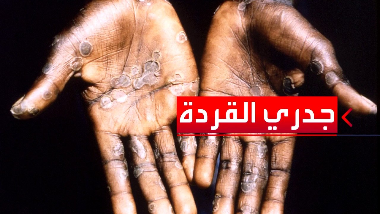 لماذا قررت الصحة العالمية تغيير اسم فيروس جدري القردة؟