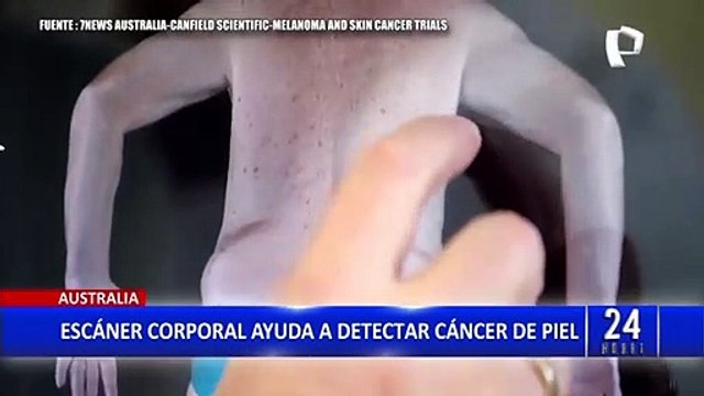 Australia: lanzan escáner corporal que ayuda a detectar cáncer de piel