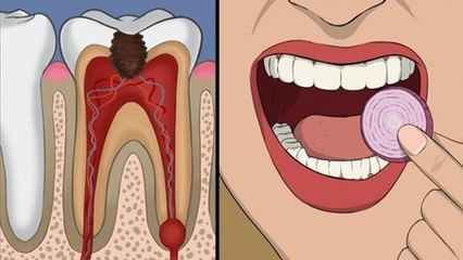 अकल दाढ़ में कीड़ा लग जाए तो क्या करें | Akal Daad Me Kida Lag Jaye To Kya Kare | Boldsky *Health