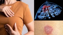 स्तनों पर पिंपल क्यों होते है | स्तनों पर पिंपल होने का कारण | Boldsky *Health