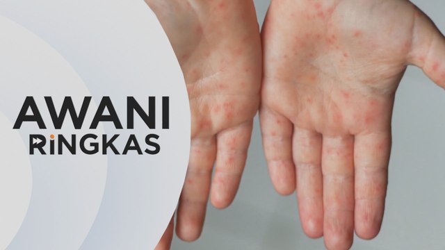 AWANI Ringkas: HFMD di Kedah catat penurunan