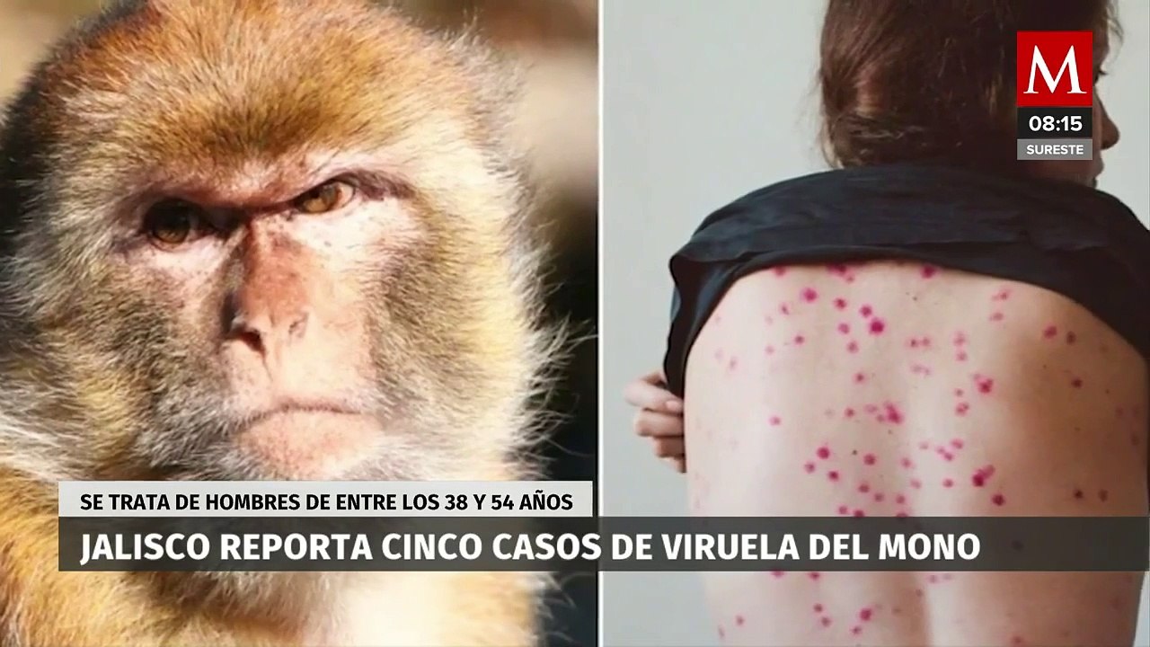 Jalisco reporta 5 casos de Viruela del mono
