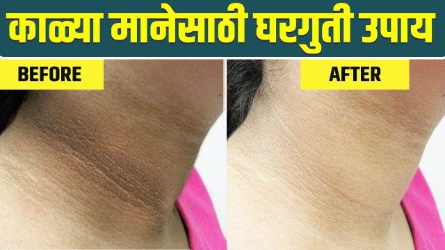 काळी मान उजळण्यासाठी घरगुती उपाय | How to Get Rid of Dark Neck | Dark Neck Treatment | Home Remedies